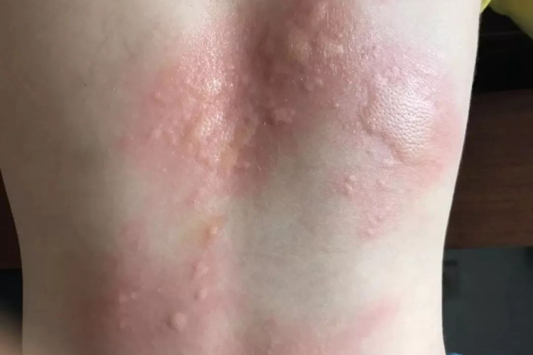 荨麻疹图 荨麻疹图