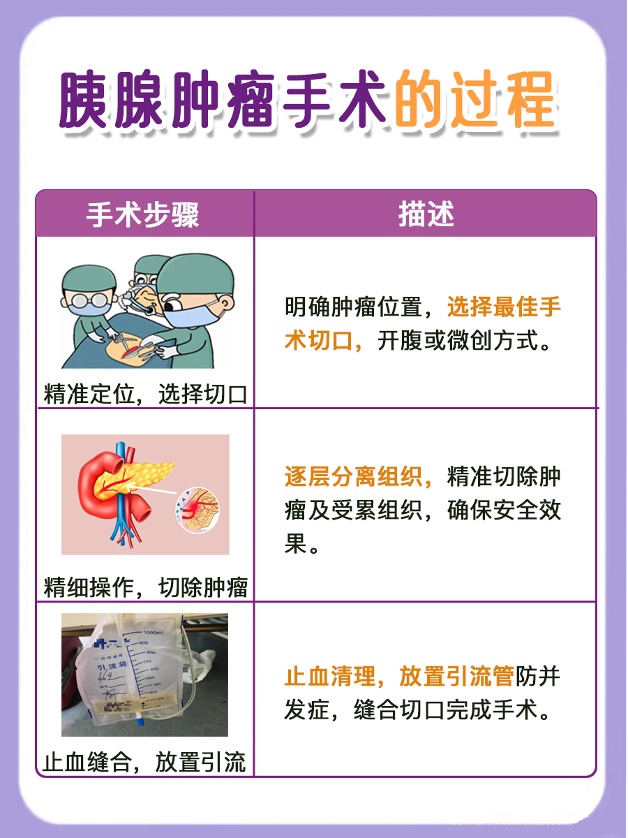 胰腺肿瘤手术的过程,你了解吗?