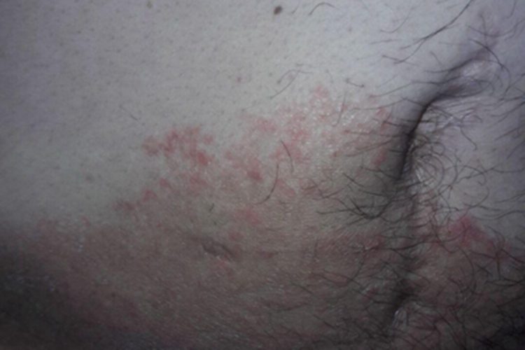 体癣腹部斑图 体癣腹部斑图