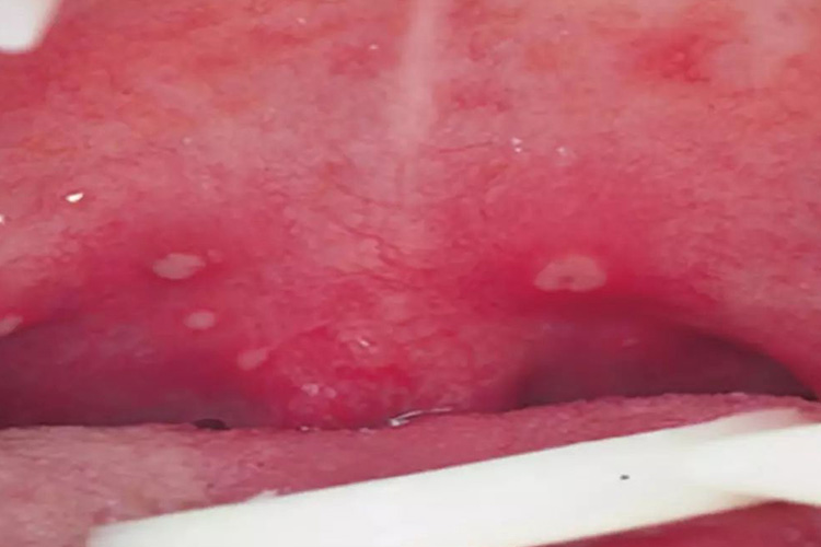 咽峡处灰白色疱疹图