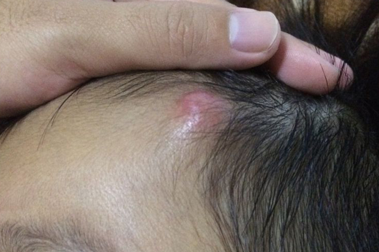 小孩额头皮脂腺囊肿图