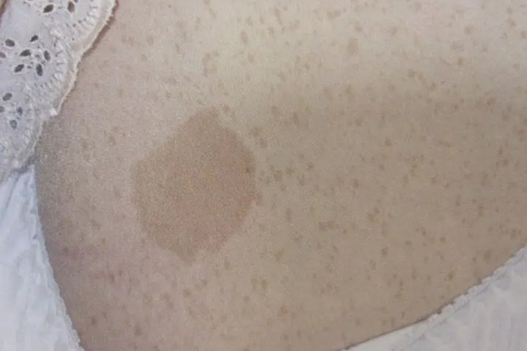 咖啡斑胸口长斑图 咖啡斑胸口长斑图