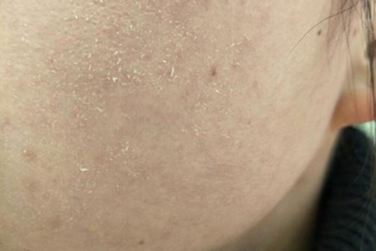 干燥综合征面部很干有脱屑图