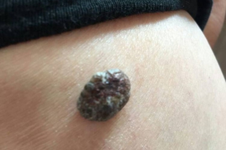 黑素瘤胳膊结节图