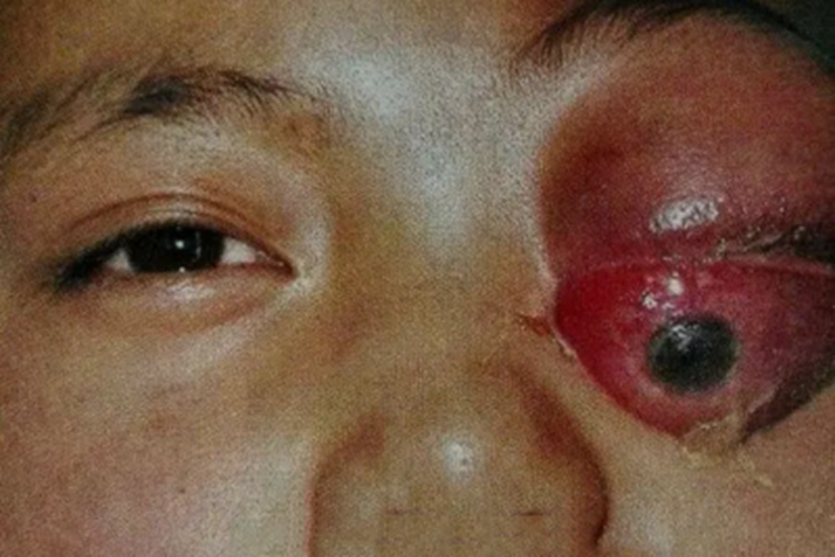 眼眶横纹肌肉瘤眼部红肿图