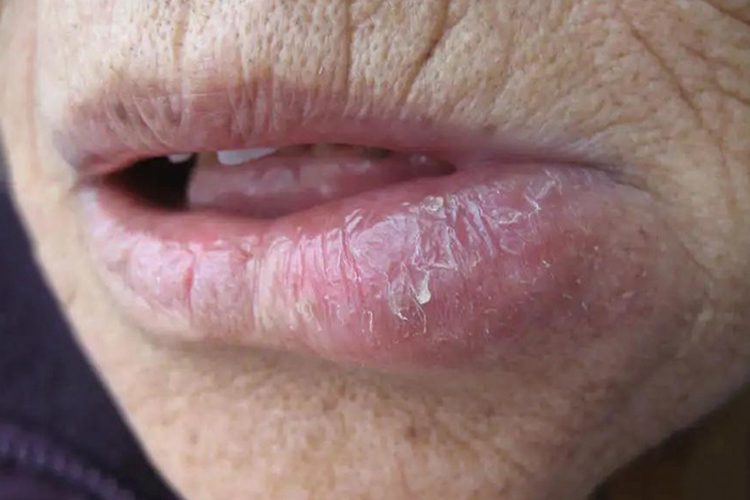 肉芽肿性唇炎图