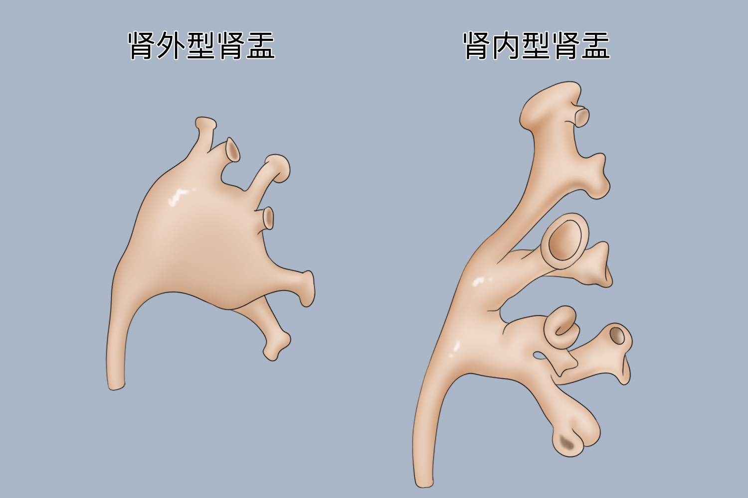肾内肾盂和肾外肾盂图