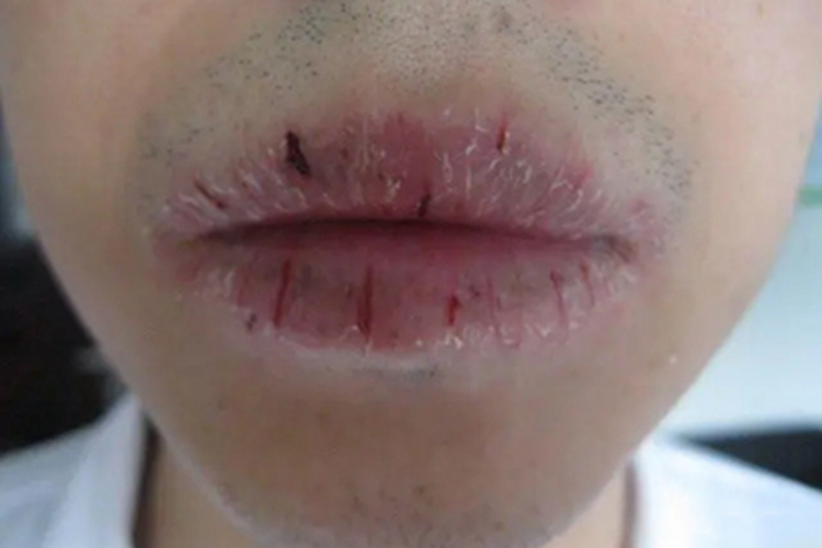 慢性唇炎嘴唇裂口图