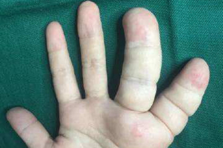 手部先天性畸形手部巨指畸形图 手部先天性畸形手部巨指畸形图