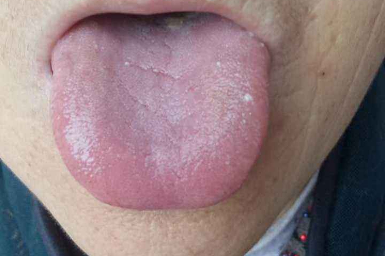 阴虚体质舌苔图