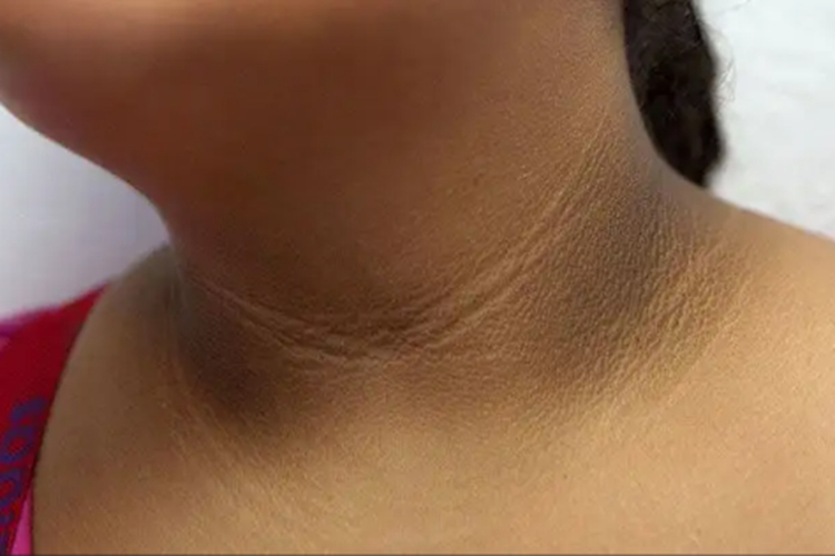 胰岛素抵抗皮肤黑图