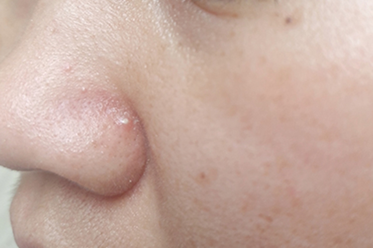 毛囊炎鼻翼疙瘩图