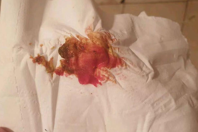 内痔最初期便血图