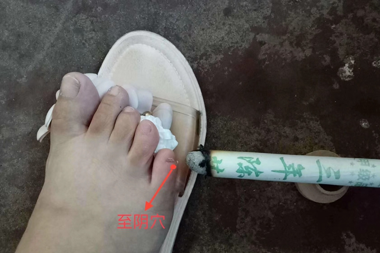 胎位不正艾条熏脚方法图片