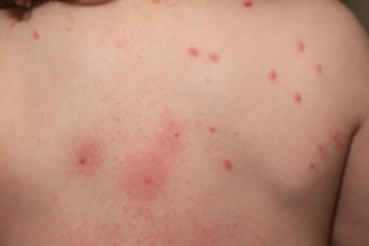 蚋叮咬引起的皮肤反应丘疹图 蚋叮咬引起的皮肤反应丘疹图