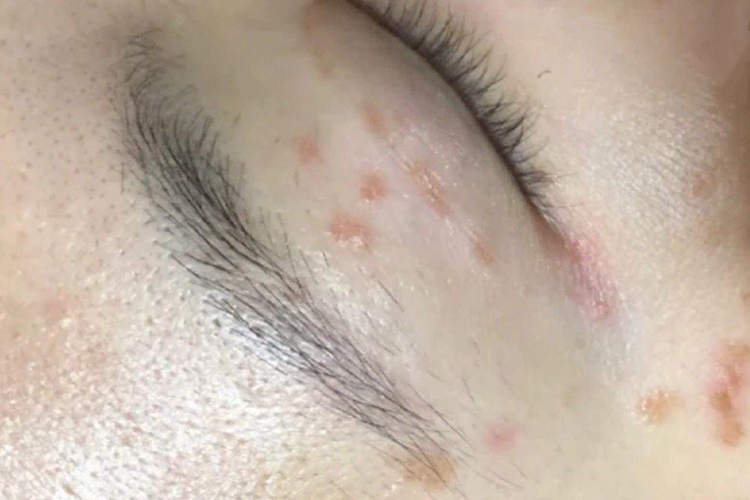 眉毛里扁平疣图