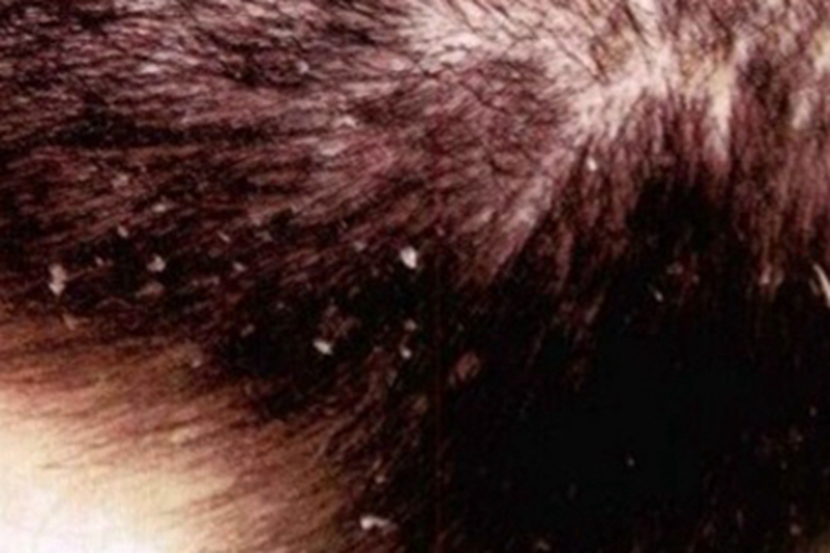 头部单纯糠疹头皮脱屑图