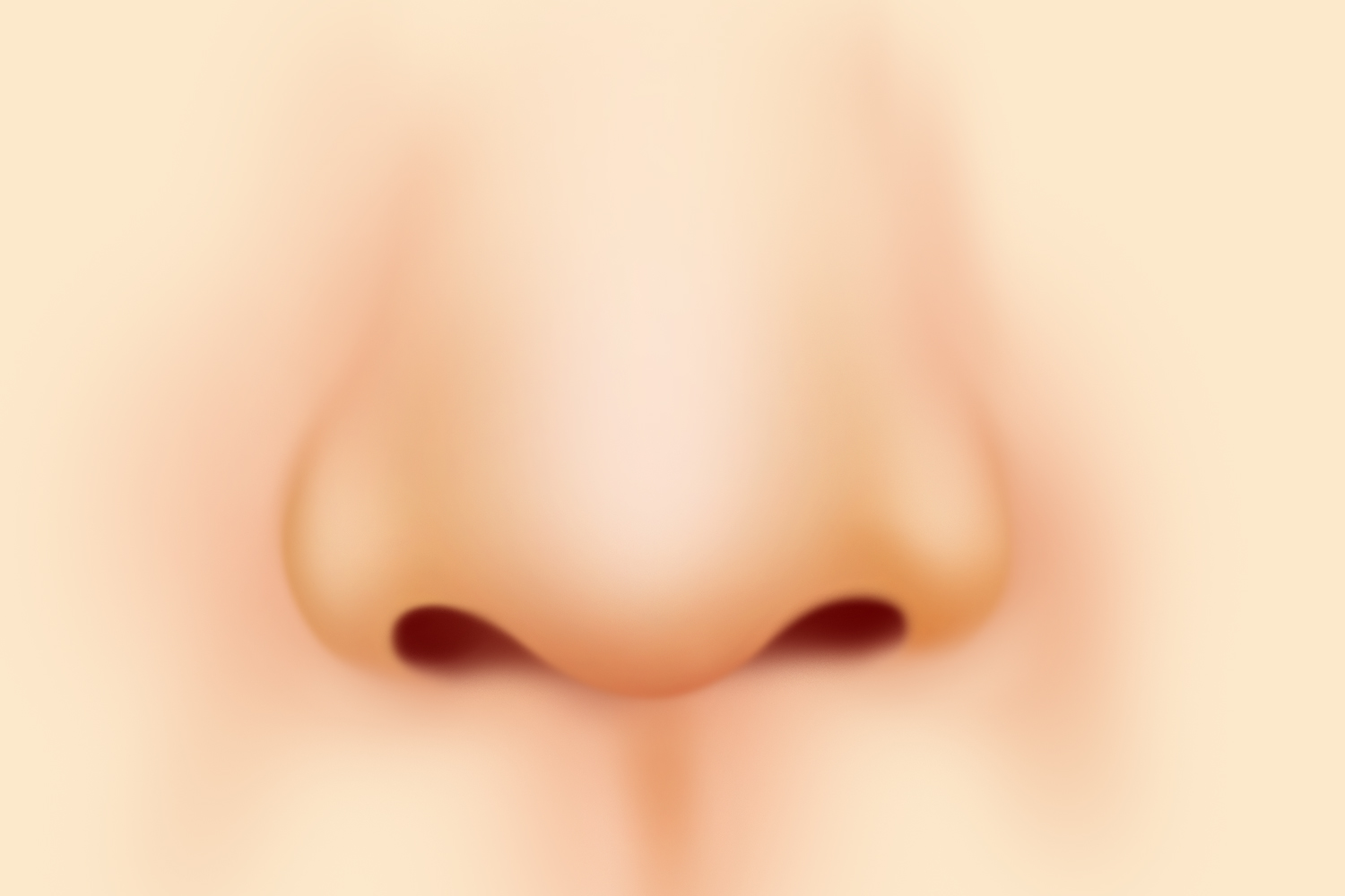 鼻翼缩小第七天拆线后图