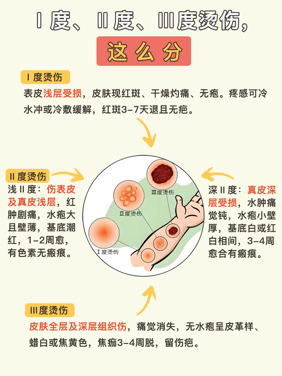 烫伤程度知多少？Ⅰ、Ⅱ、Ⅲ度烫伤原来这么分！