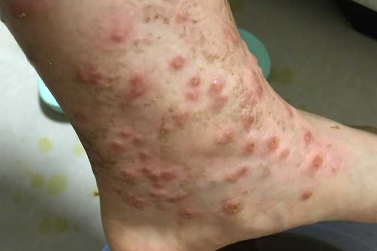 虫咬皮炎红肿图