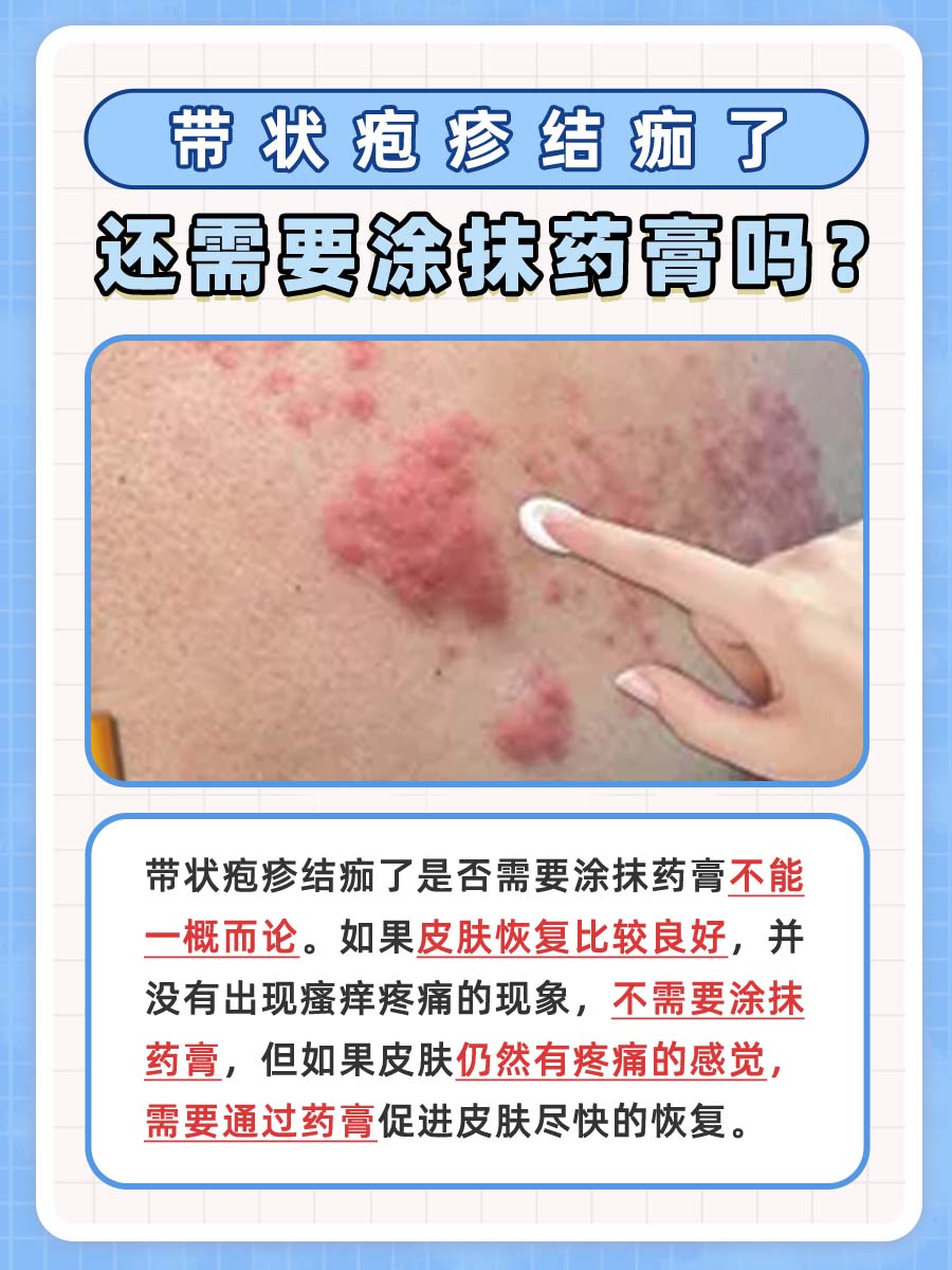 带状疱疹结痂了还需要涂抹药膏吗？答案来了