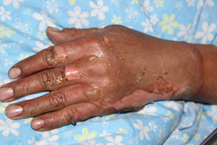 浅Ⅱ度烧伤手背脱皮图 浅Ⅱ度烧伤手背脱皮图