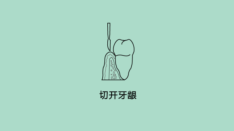 切开牙龈.png