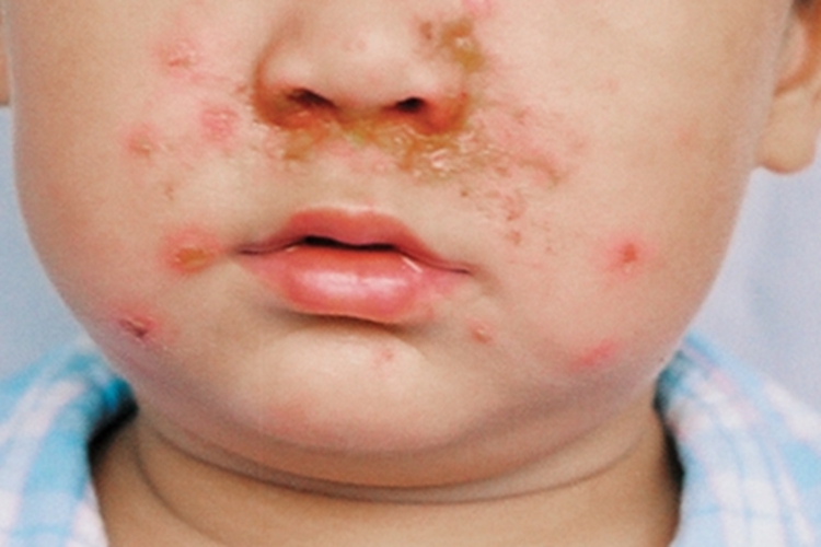 非大疱型脓疱疮鼻翼丘疹图