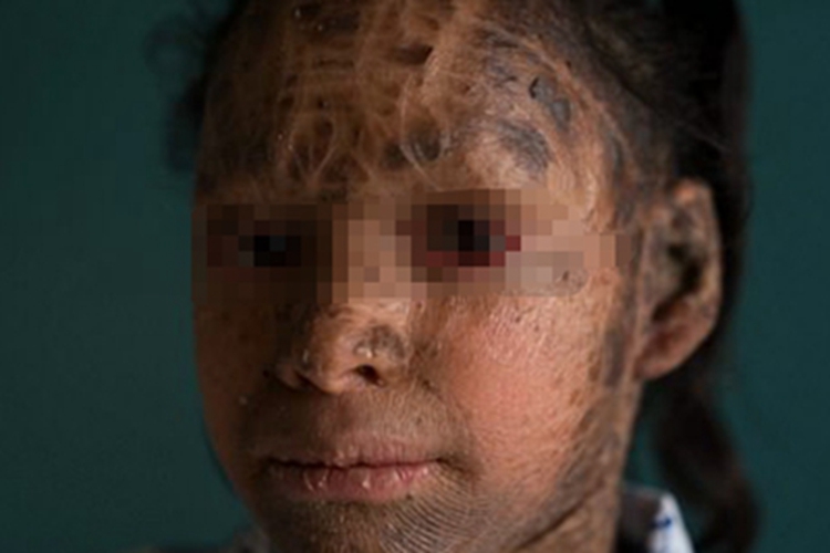 X连锁鱼鳞病黑痂图 X连锁鱼鳞病黑痂图