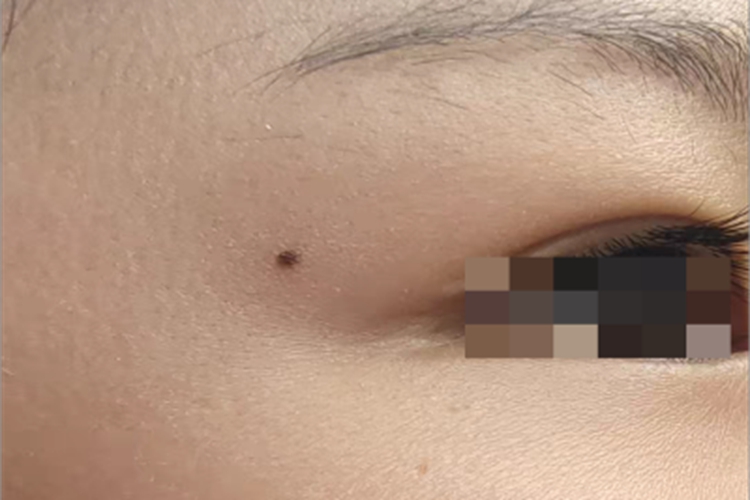 交界痣小疙瘩图 交界痣小疙瘩图