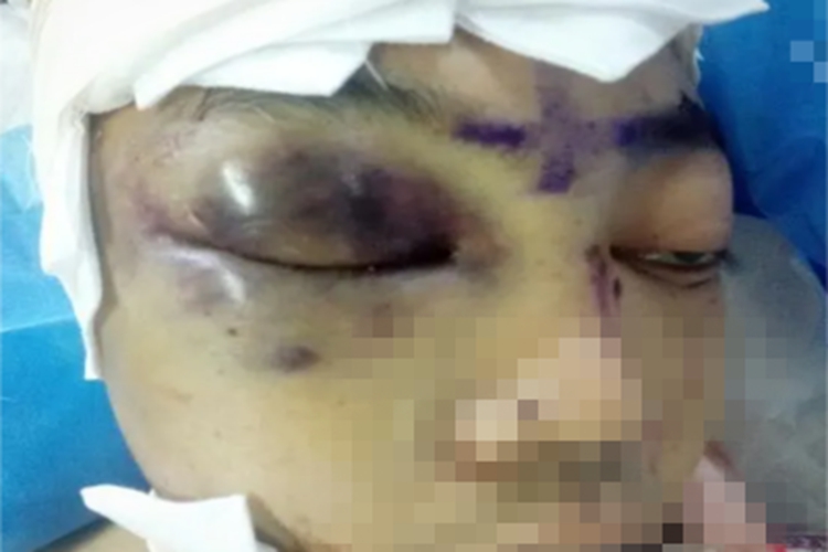 眼眶血肿症状图 眼眶血肿症状图