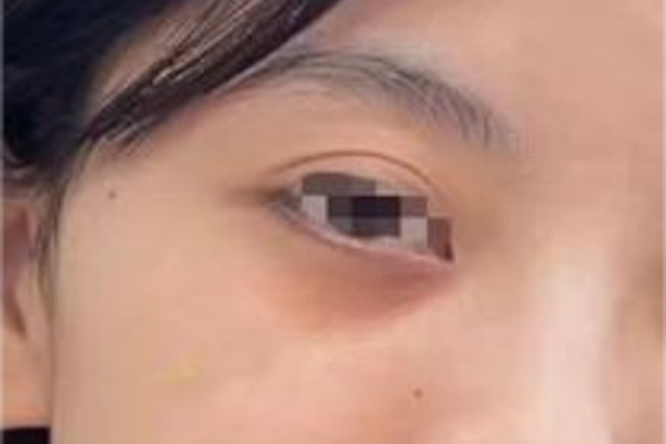 眶周黑变眼下颜色变深图