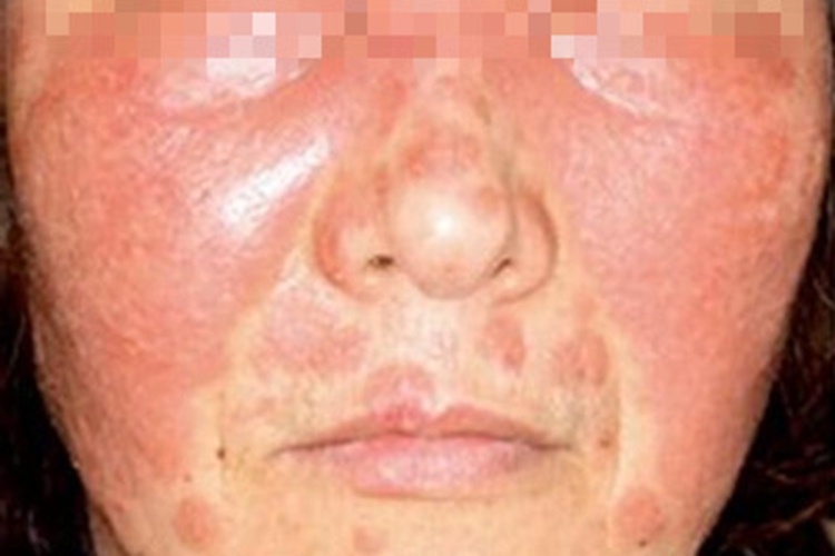 红斑型天疱疮面部红斑图