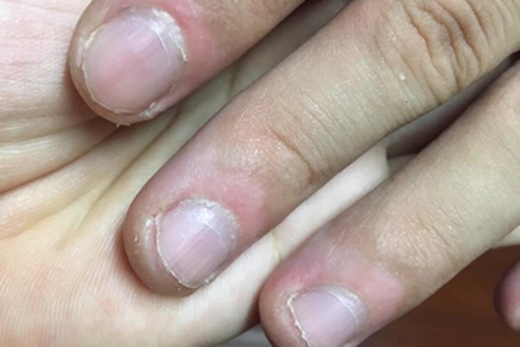 面肢端型白癜风手指尖症状图