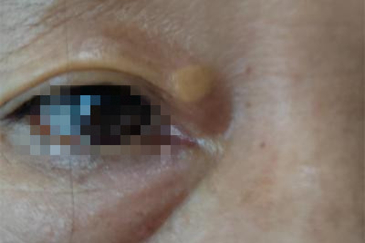 睑黄瘤上眼睑有疙瘩图