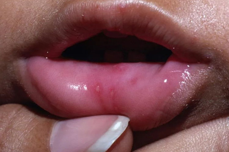 疱疹样口腔溃疡图 疱疹样口腔溃疡图