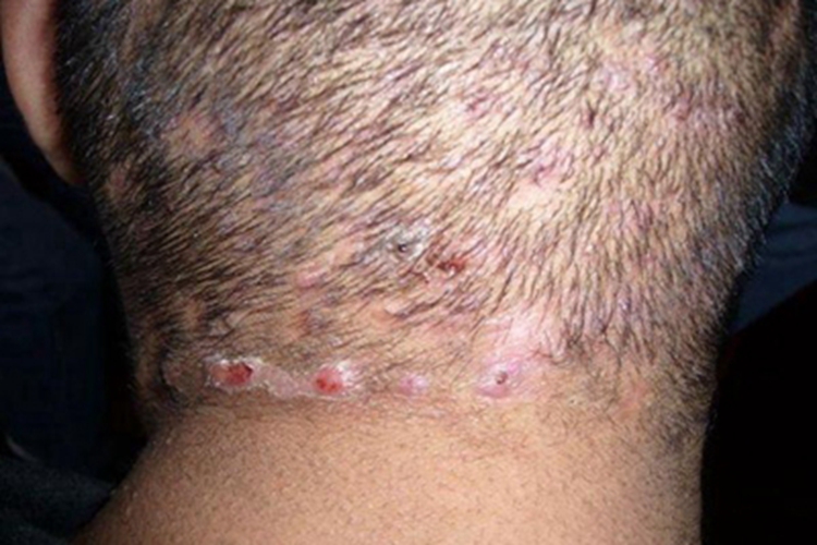 聚合性痤疮头皮症状图