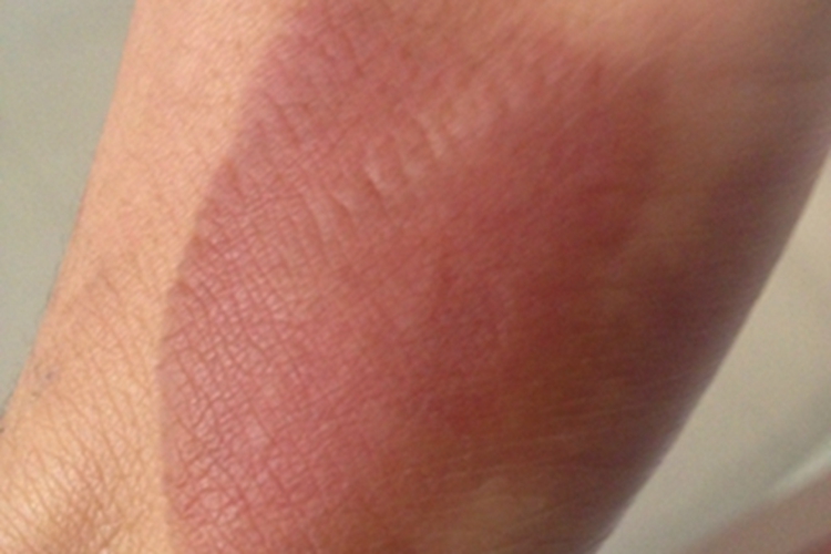 一度烫伤手背皮肤发红图