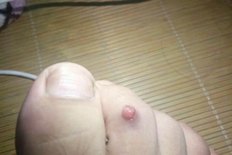 小汗腺汗孔瘤脚趾症状图