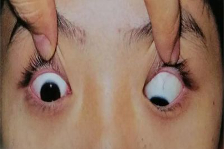 急性铊中毒眼球变形图