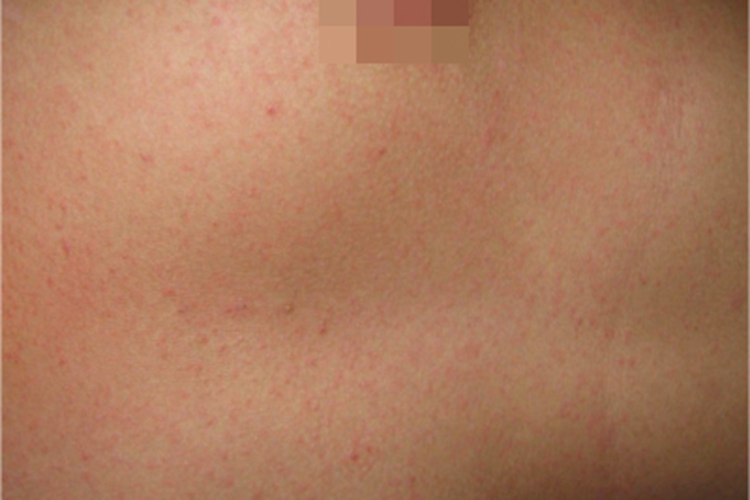 普通型猩红热丘疹图