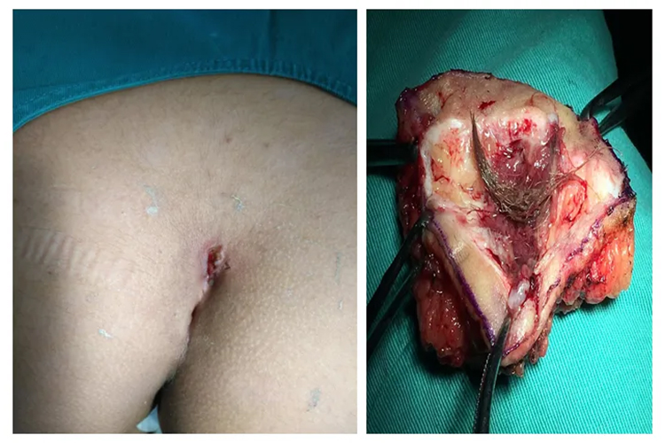 尾椎上藏毛窦图