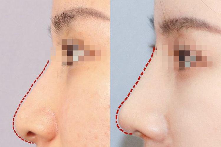 隆鼻前后对比效果图 隆鼻前后对比效果图