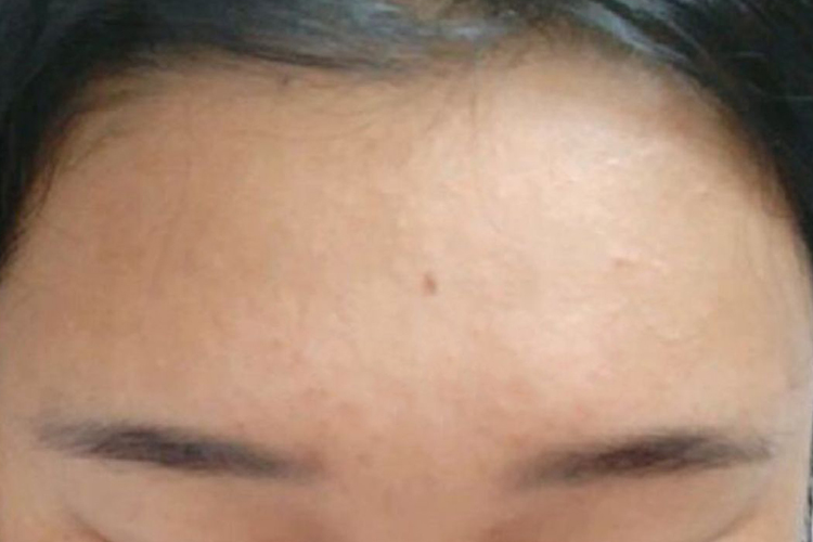 闭口粉刺明显改善图