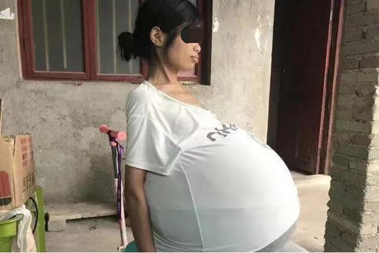 卵巢癌肚子大图 卵巢癌肚子大图