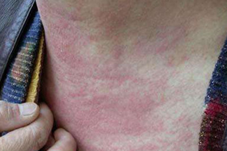 自身敏感性皮炎颈部发红图