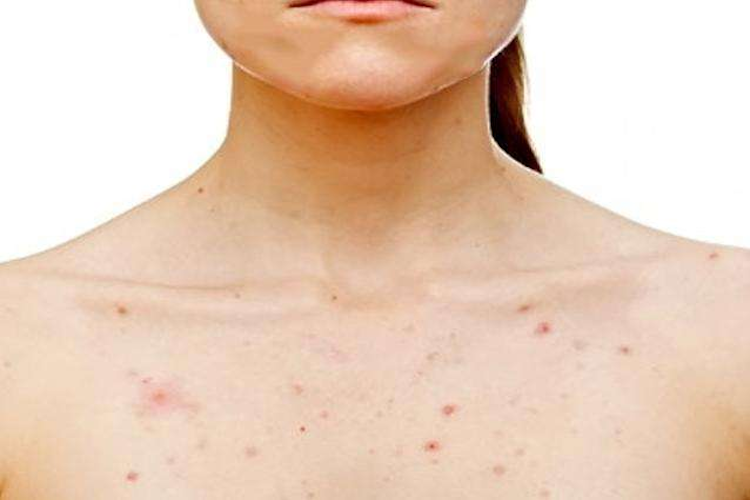胸部痤疮图 胸部痤疮图