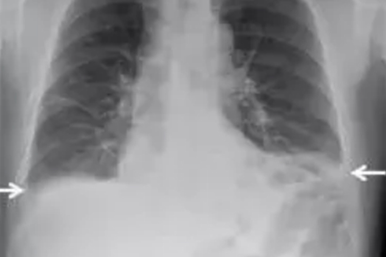 胸腔积液图 胸腔积液图