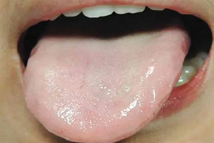 气血两虚齿痕舌图