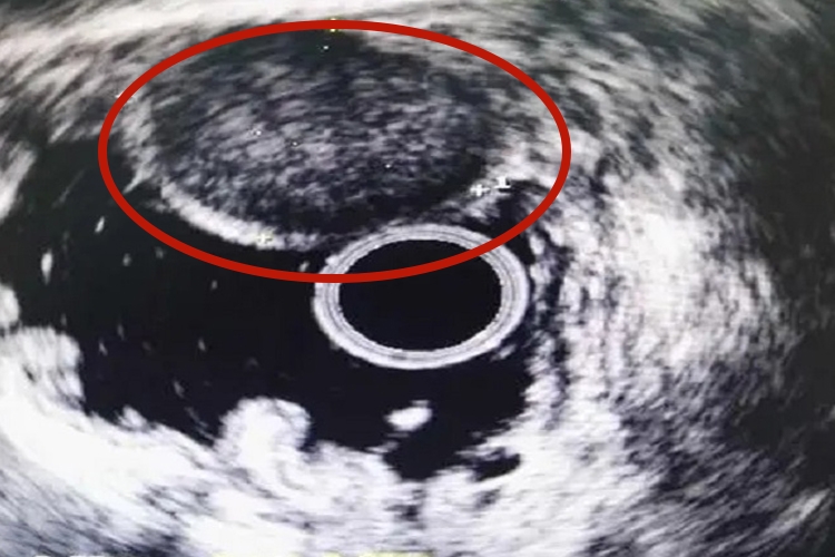 胃囊肿超声胃镜影像图